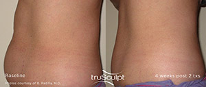 Trusculpt ID: Defining Your Body ID With Personalized Body Sculpting