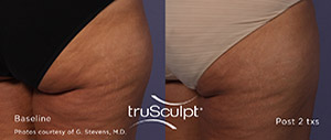 Trusculpt ID: Defining Your Body ID With Personalized Body Sculpting