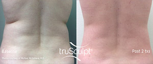 Trusculpt ID: Defining Your Body ID With Personalized Body Sculpting